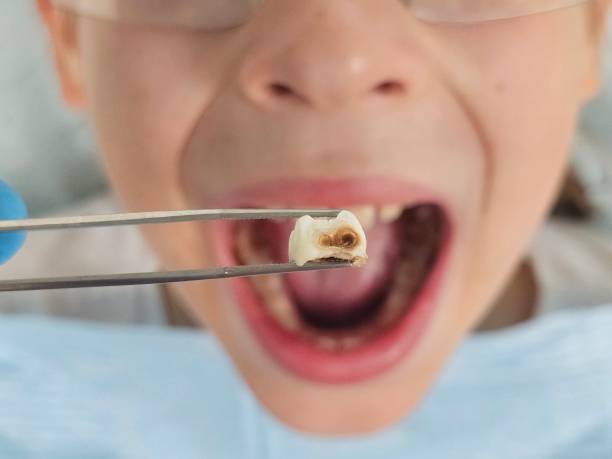 Best Cracked Tooth Emergency Dentist  in Northwest Harwinton, CT